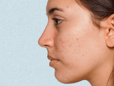 Acne – A Common Problem, Its Causes And Cure