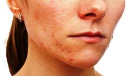 Skincare Tips For Hormonal Acne