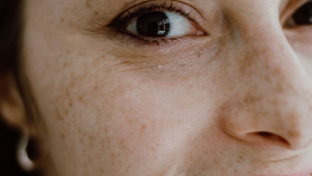 Close-up of bare skin around the eye, nose and cheek, freckles visible, no makeup