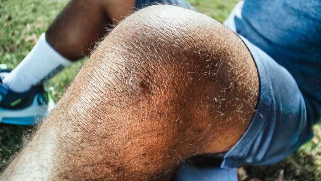 Close-up of dry, rough skin on a knee outdoors
