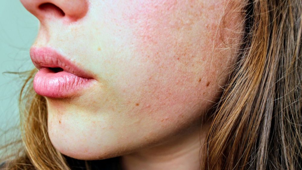 Close view of a woman's cheek, jaw and lips in natural daylight, bare skin with its fine texture and a little redness visible