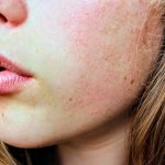 Close view of a woman's cheek, jaw and lips in natural daylight, bare skin with its fine texture and a little redness visible