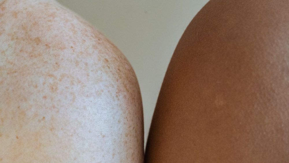 Close-up of a freckled shoulder beside another person's shoulder, natural light